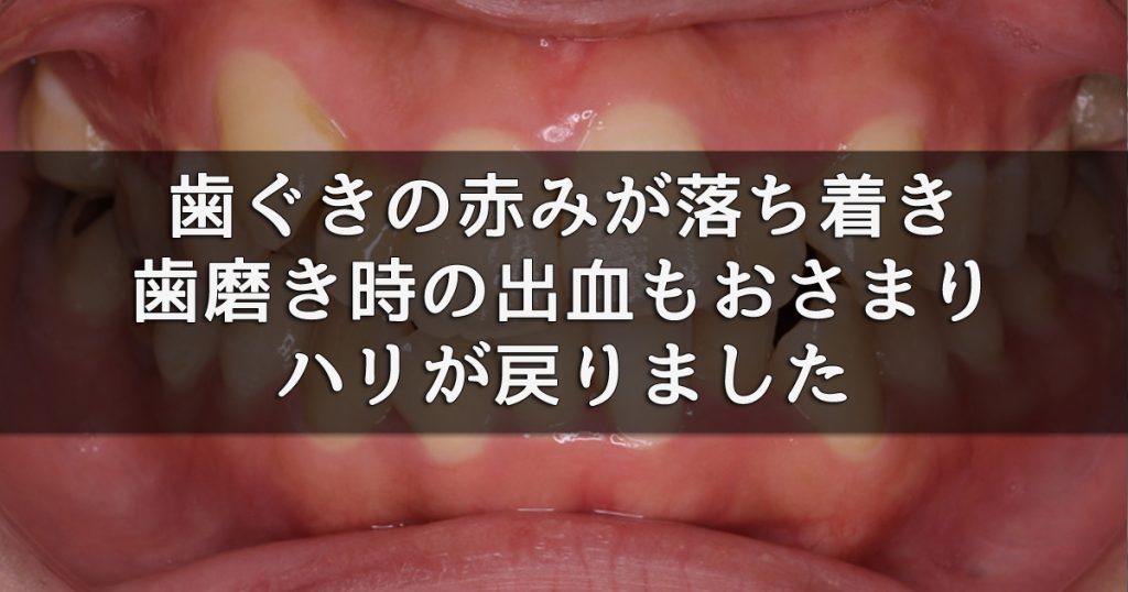 歯周病治療後、歯ぐきの赤みが落ち着き、歯磨き時の出血もおさまりハリが戻りました