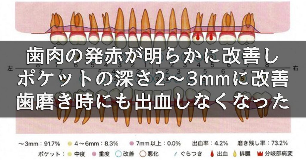 歯肉の発赤が明らかに改善し、腫れも引いてポケット深さは2～3mmに改善。歯磨き時にも出血しなくなりました。