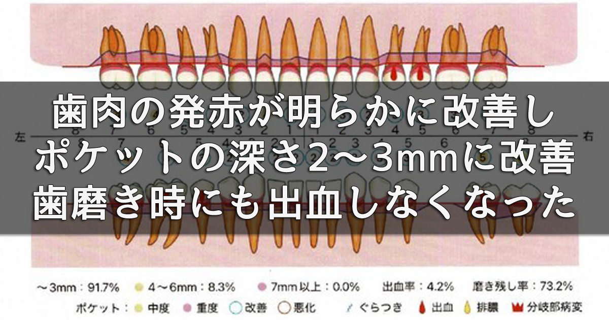 歯肉の発赤が明らかに改善し、腫れも引いてポケット深さは2～3mmに改善。歯磨き時にも出血しなくなりました。