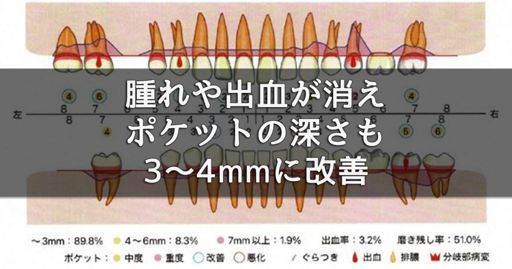 治療1カ月後は、腫れや出血が消え、ポケット深さも3〜4mmに改善。