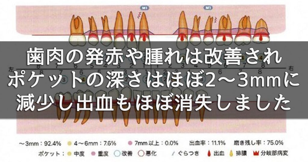 歯周病治療3週間後、再評価すると歯肉の発赤や腫れは改善され、ポケットの深さは歯周炎基準の4mmが激減しほぼ2～3 mmに減少し、出血もほぼ消失しました。